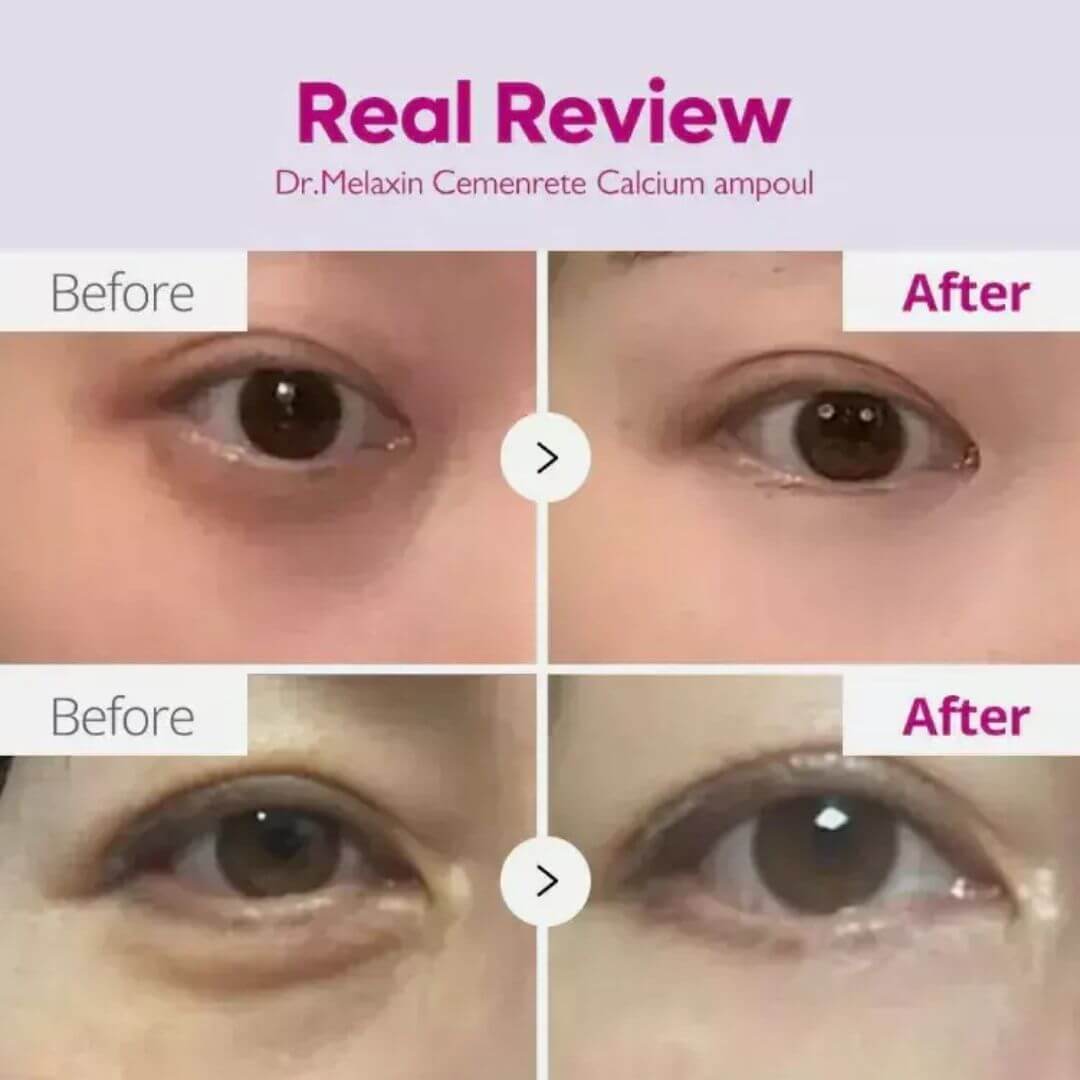 Κρέμα ματιών για άμεσο lifting - Eyephalt Eyebag Cream 10 gr | Dr. melaxin