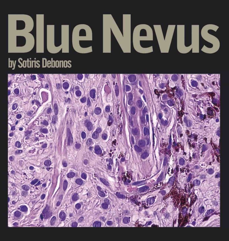 Sotiris Debonos - Blue Nevus